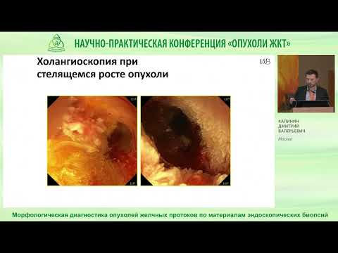 Видео: Морфологическая диагностика опухолей желчных протоков по материалам эндоскопических  биопсий