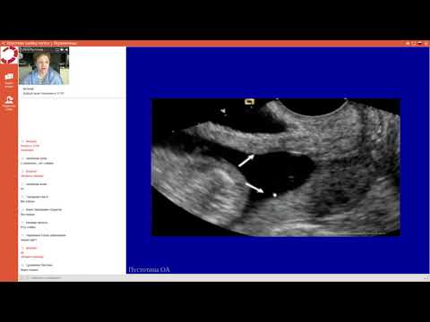 Видео: Экспертология | Короткая шейка матки у беременных Пустотина О.А.