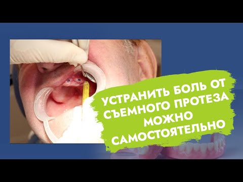 Видео: Съемный зубной протез натирает десну.