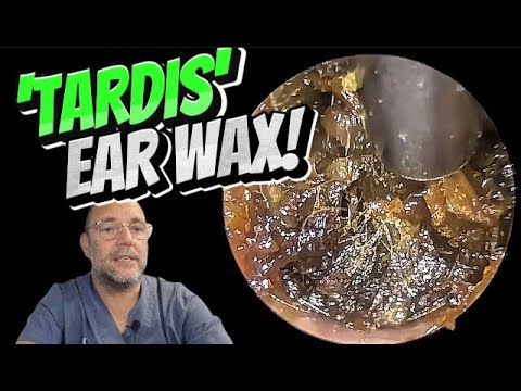 Видео: Ушная сера «ТАРДИС»! 329 #ухо #ушнаясера #удалениеушнойсеры #асмр #удовлетворение #длявас #fyp #f...