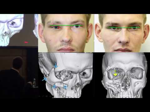 Видео: Бельченко В. А. Лечебно-диагностическая тактика при переломах нижней стенки глазницы