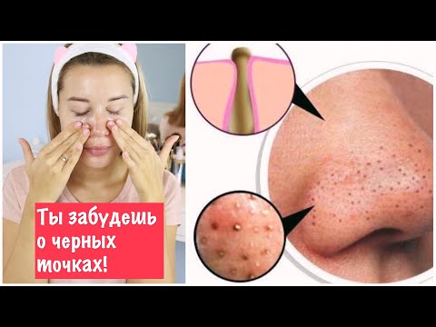 Видео: ТЫ ЗАБУДЕШЬ О ЧЁРНЫХ ТОЧКАХ С ЭТИМ ПРОСТЫМ РЕЦЕПТОМ