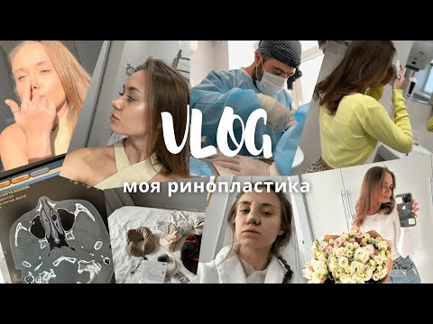 Видео: Ринопластика. VLOG//моя история. Как выбирала врача? Цена? ДО и ПОСЛЕ