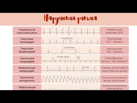 Видео: Норма и патология на ЭКГ: Нарушения Ритма