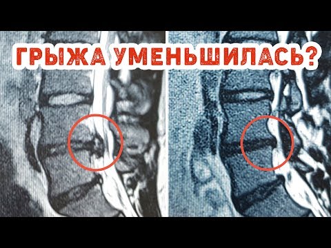 Видео: Грыжа диска. Мой опыт лечения межпозвоночной грыжи
