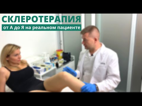 Видео: Процедура склеротерапия, от А до Я. На реальном примере.