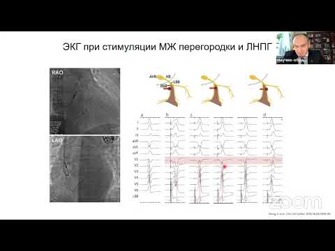 Видео: Особенности ЭКГ в 12 отведениях при стимуляции пучка Гиса и области левой ножки пучка Гиса