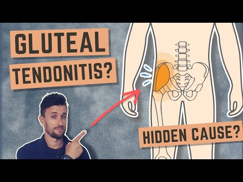 Видео: Скрытая причина тендинита ягодичных мышц (и упражнения для его лечения)