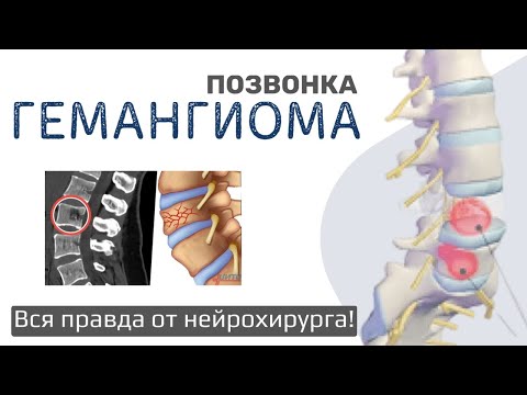 Видео: ГЕМАНГИОМА позвонка! Вся правда от нейрохирурга!