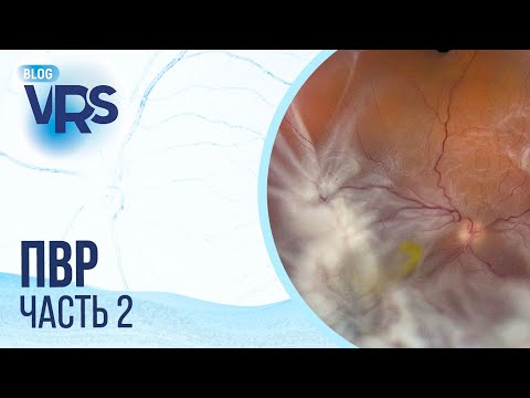 Видео: Пролиферативная витреоретинопатия