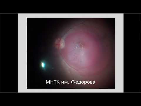 Видео: Субретинальные кровоизлияния