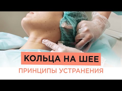 Видео: Как убрать КОЛЬЦА НА ШЕЕ? Разбираем варианты процедур