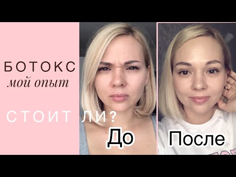 Видео: Первый ботокс в 35.  Мой опыт. Дневник наблюдения.