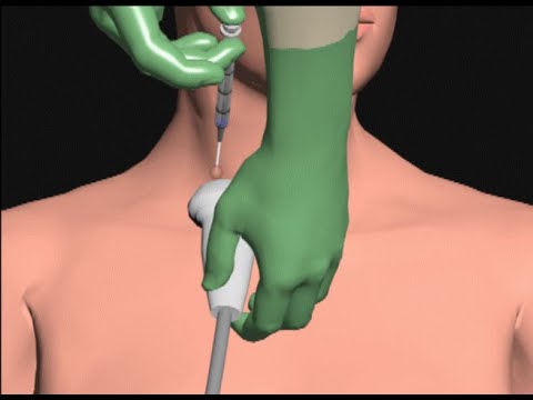 Видео: Установка центральной линии, автор Кэл Шипли, доктор медицины.