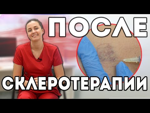 Видео: Период восстановления после склеротерапии