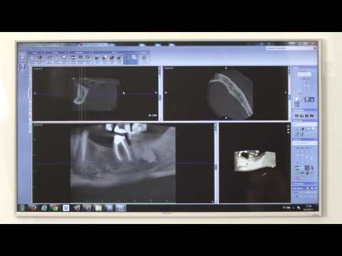 Видео: Компютърно планиране на импланти