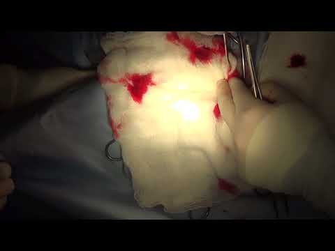 Видео: Хирургическое лечение межтарсального артродеза, подвывиха ахиллова сухожилия у собаки