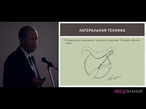 Видео: 13 Современные подходы при тимпанопластике