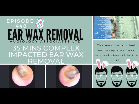 Видео: 35-МИНУТНОЕ КОМПЛЕКСНОЕ УДАЛЕНИЕ СЕРЫ ИЗ УШЕЙ - EP449