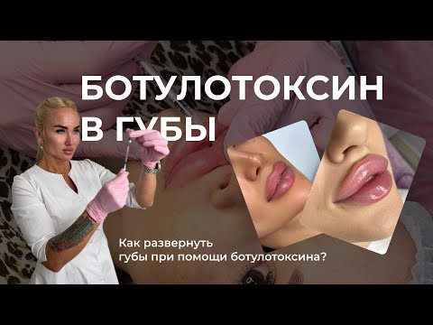 Видео: Ботулотоксин в губы | Как при помощи ботулотоксина развернуть губу? | Техника