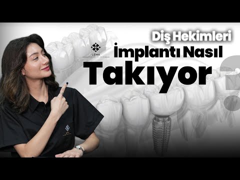 Видео: 🤍 Как стоматологи устанавливают зубные импланты? Больно ли это? — Стоматологическая клиника Lema
