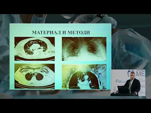 Видео: 64. Миниинвазивен хирургичен подход при подкожен емфизем, Minimally invasive approach in...