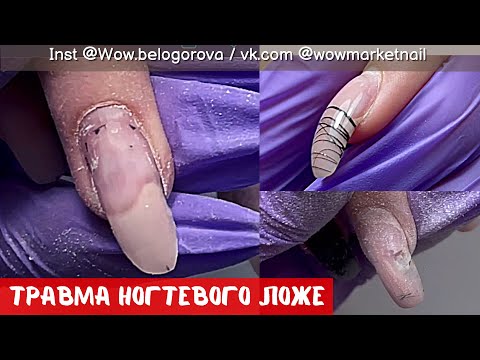 Видео: Клюющие ногти | Переломанные точки вроста | Что делать с травмой
