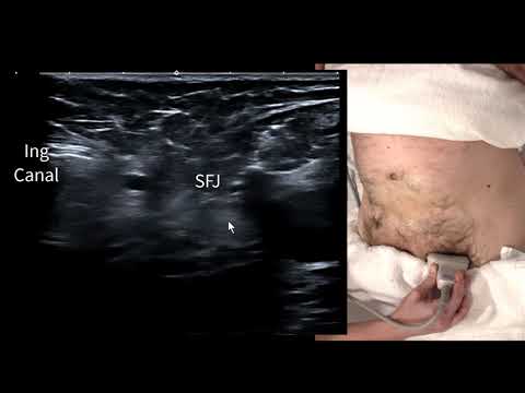 Видео: Бедренная грыжа + паховая грыжа, ультразвуковое сканирование в реальном времени для прямого и неп...