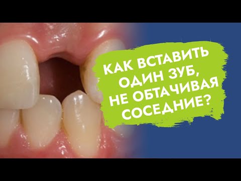 Видео: Протезирование одного зуба.