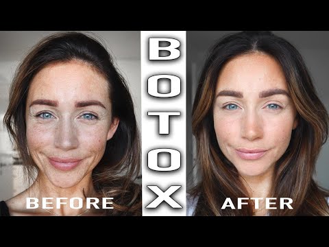Видео: Лечение ботоксом до и после