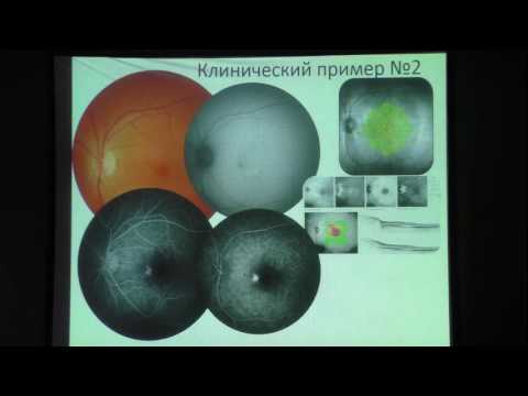 Видео: Эффективность ФДТ при хронических формах ЦСХРП Докладчик Семёнова Т.Н.