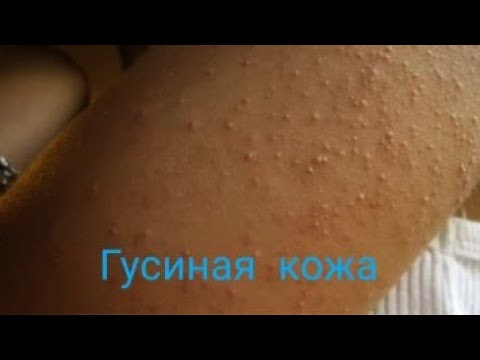 Видео: Гусиная кожа. Фолликулярный кератоз. Аптечные средства от гусиной кожи.