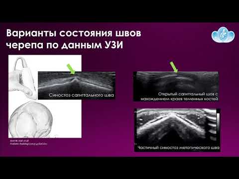Видео: 13. Ультразвуковое исследование -метод 1линии визуализации при подозрении на краниосиностоз у детей