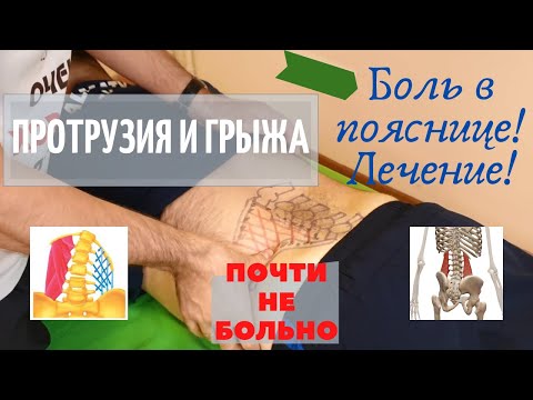 Видео: Боль в пояснице. Протрузия, грыжа. Лечение. Кинезиология