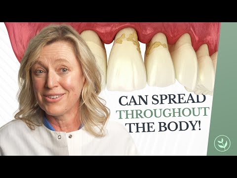 Видео: Здоровье десен влияет на весь организм