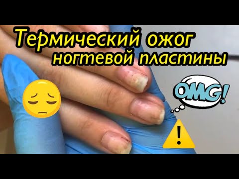 Видео: Термический ожог ногтевой пластины 😱👀🆘⚠️