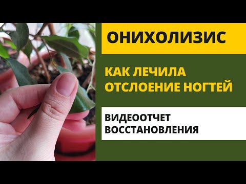 Видео: Онихолизис отслоение ногтевой пластины от ложа лечение как лечить