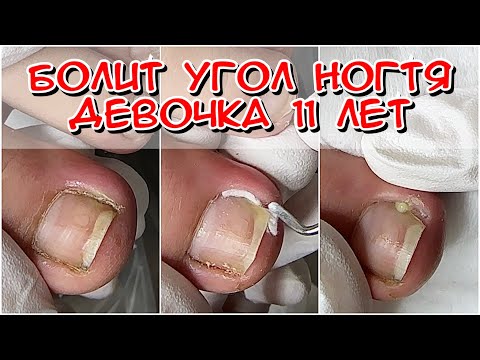 Видео: Болит угол ногтя у девочки 11 лет / Вросший ноготь у ребенка / Болит палец у ребенка  что делать /
