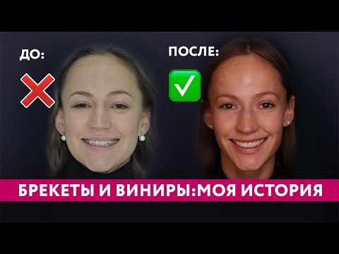 Видео: Я ПОТРАТИЛА 600 ТЫСЯЧ и 3 ГОДА: БРЕКЕТЫ И ВИНИРЫ - моя честная история идеальной улыбки