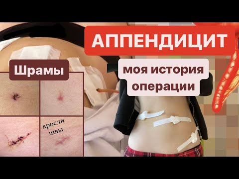 Видео: АППЕНДИЦИТ - мой главный страх | вросли швы, моя история