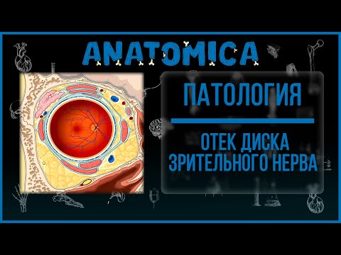 Видео: Отек диска зрительного нерва / Папиллоэдема (Papilloedema) / Патология