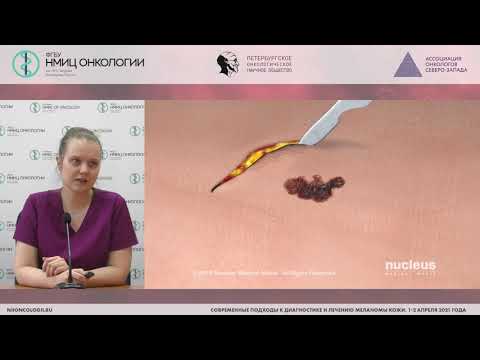 Видео: Хирургическое стадирование сегодня. Эксцизия против широкого иссечения (Эберт М.А.)