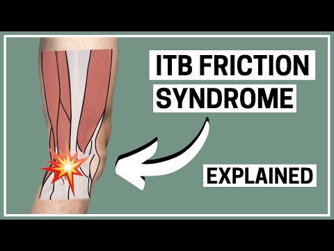 Видео: Колено бегуна – синдром трения ITB, диагностика и лечение