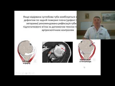 Видео: Звичний звих плеча