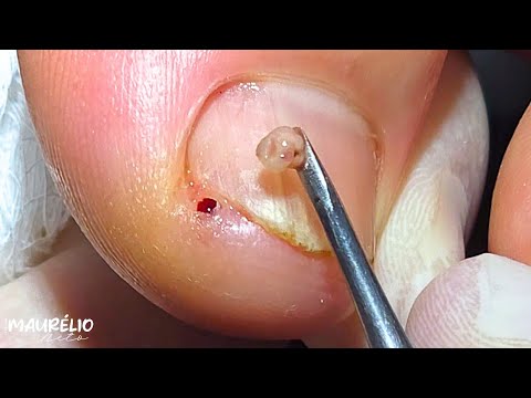 Видео: ЗУДЯЩЕЕ ПЯТНО НА НОГЕ