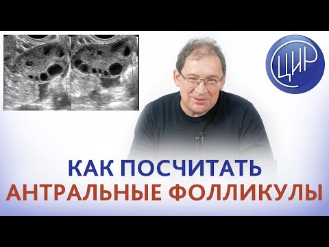 Видео: Подсчёт антральных фолликулов (AFC). Как правильно считать антральные фолликулы.