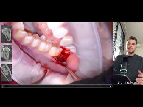 Видео: УДАЛЕНИЕ РЕТИНИРОВАННОГО ТРЕТЬЕГО МОЛЯРА НИЖНЕЙ ЧЕЛЮСТИ