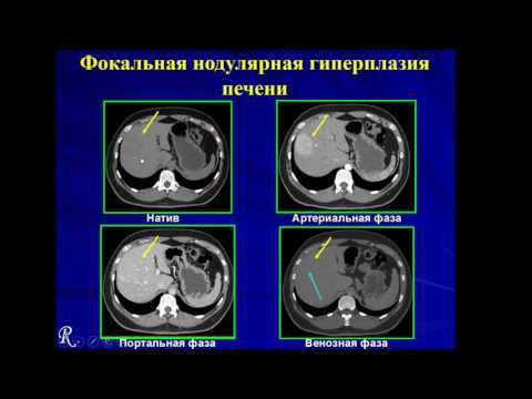 Видео: Лекция: «Многофазная компьютерная томография в оценке гепатобилиарной системы»