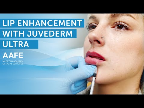 Видео: Увеличение объема губ с помощью Juvederm Ultra! | AAFE
