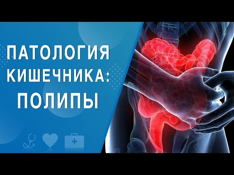 Видео: Патология кишечника: полипы. На здоровье 03.10.2020
